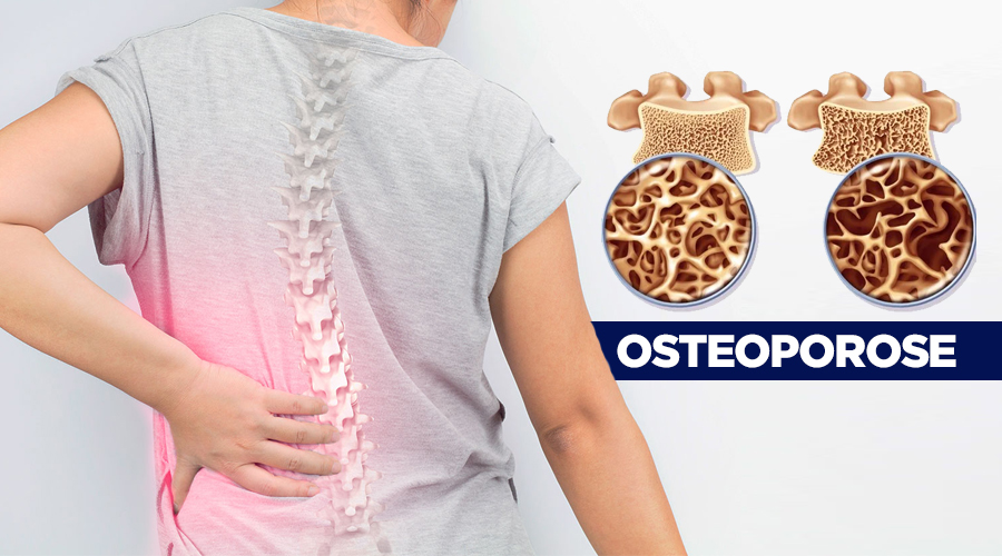 Fratura por osteoporose pode causar déficits neurológicos