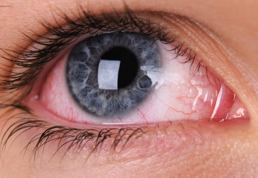 Alergia ocular pode afetar saúde mental e social do paciente